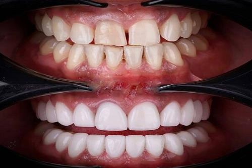 هشدار دندانپزشکان درباره ی عوارض لمینت های بی کیفیت